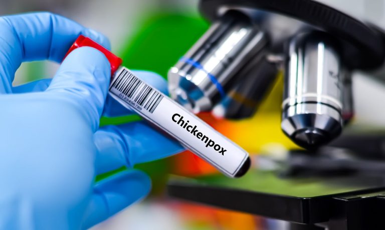Kerala Responds to Chickenpox Outbreak in Kollam